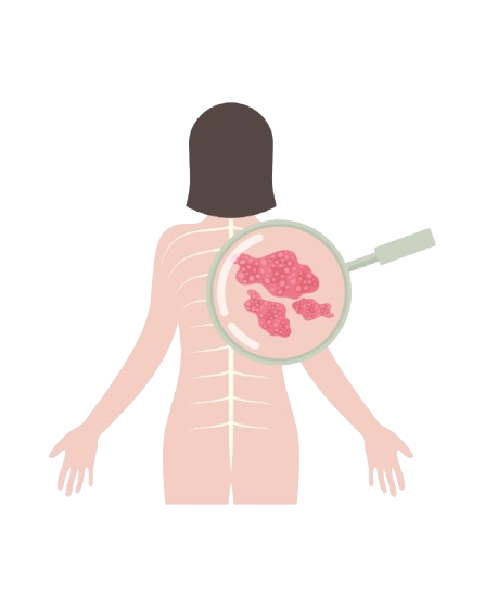 Shingles treatment